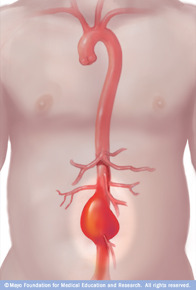 L'aorta e l'aneurisma dell'aorta addominale