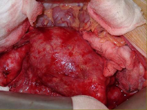 Aneurisma dell'aorta addominale: accesso laparotomico standard